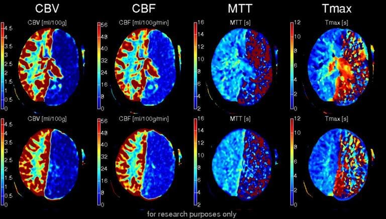 Ct perfusionale cerebrale, utile a studiare i flussi ematici cerebrali indicando quali territori sono già morti e quali in penombra ischemica